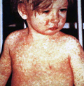10-ways-to-beat-measles-in-Europe