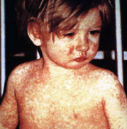 Nobody-should-die-from-measles