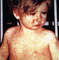 Measles-outbreak
