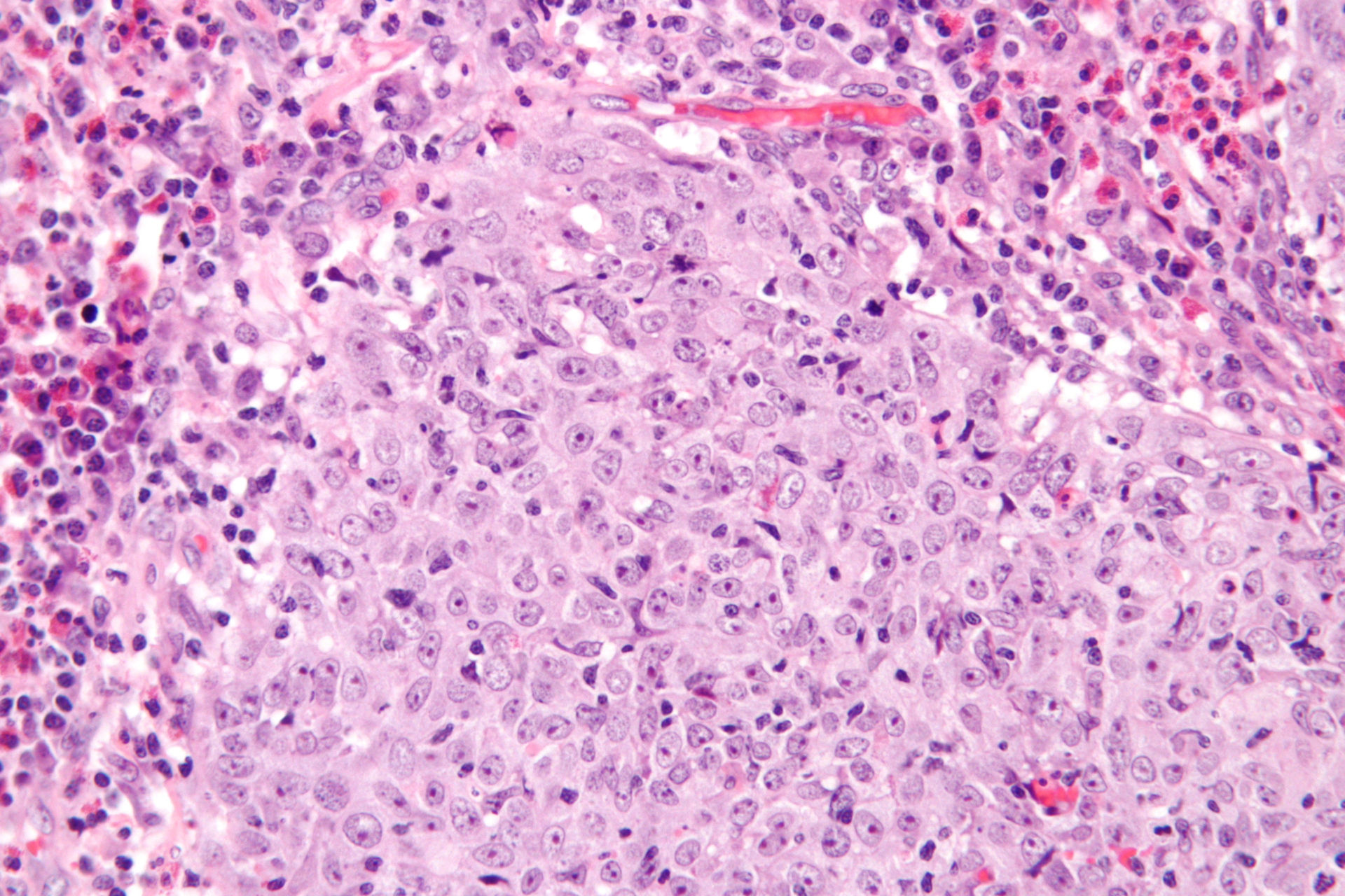 Glassy cell carcinoma, very high magnification