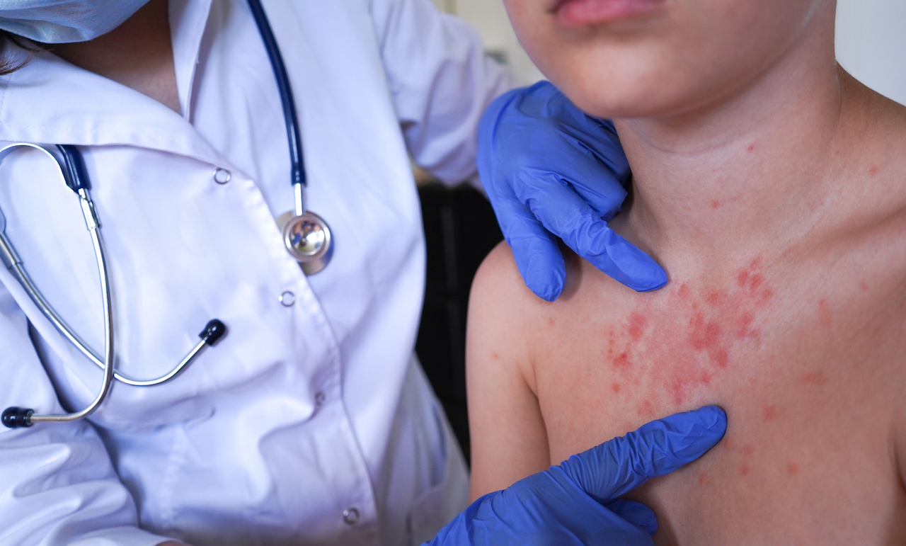 Measles outbreak in Sweden: most cases in unvaccinated children